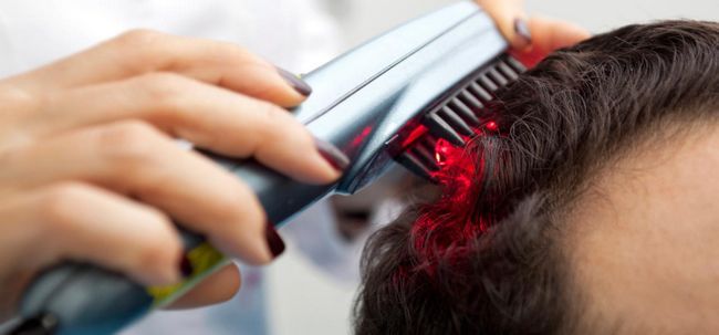 La terapia con láser: una forma novedosa para la Lucha contra la pérdida del cabello
