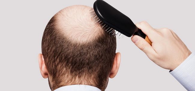 Mesoterapia para el crecimiento del pelo - ¿Funciona?