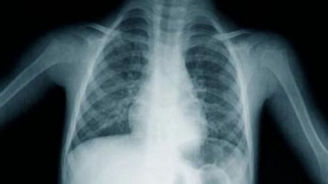 Enfermedad pulmonar rara en niños - Una nueva terapia génica y celular
