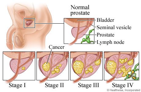 Los síntomas del cáncer de próstata - la forma de conocer y reconocer?
