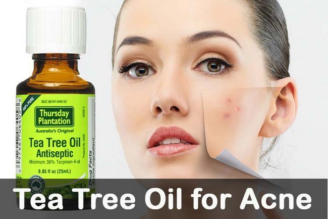 Aceite de árbol de té para el acné