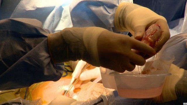 El primer europeo trasplante de riñón ojo de la cerradura por un cirujano indio