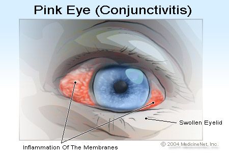Consejos para prevenir la propagación de los ojos de color rosa / conjuntivitis