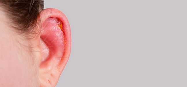 Top 10 eficaz Remedios caseros para las infecciones del oído