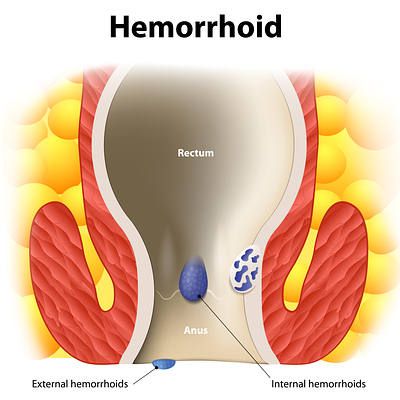 hemorroides (almorranas)