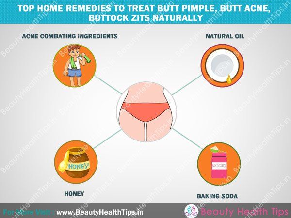 TOP-hogar-remedios-to-treat-extremo-grano, -butt-acné, -buttock-granos-natural