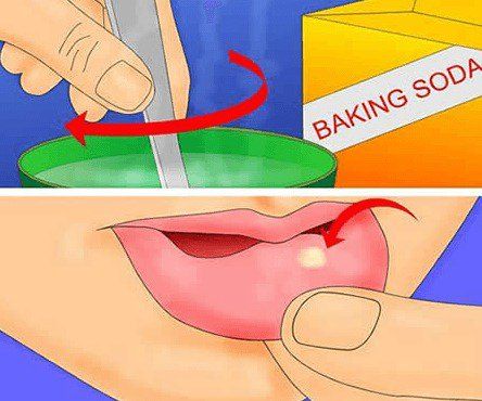 remedios caseros para las úlceras de la boca, llagas bucales