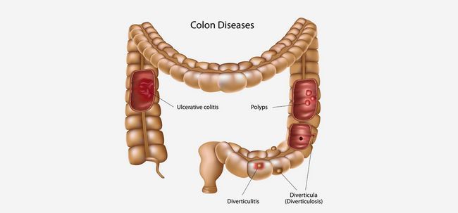 Colitis Ulcerosa de la dieta - 5 eficaces formas naturales para curar la colitis ulcerosa