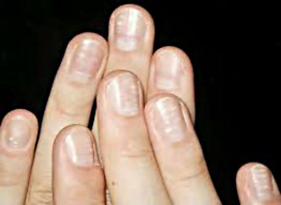 Formas de eliminar las manchas blancas en las uñas de los dedos?