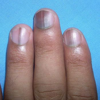 ¿Qué son los efectos de los nutrientes Deficiencias en las uñas y cómo corregirlos?