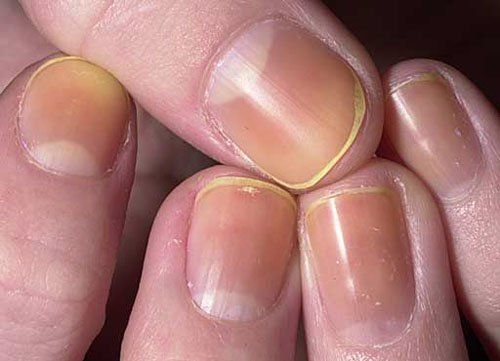¿Qué es el síndrome de las uñas amarillas y sus remedios
