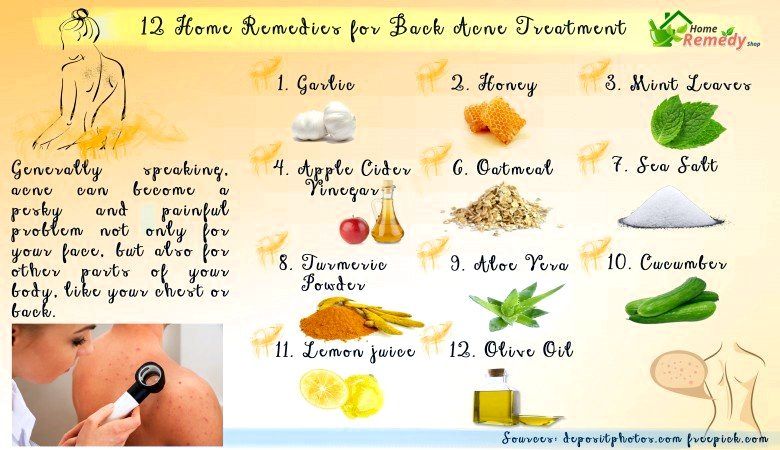 12 Remedios caseros para el acné Tratamiento Volver