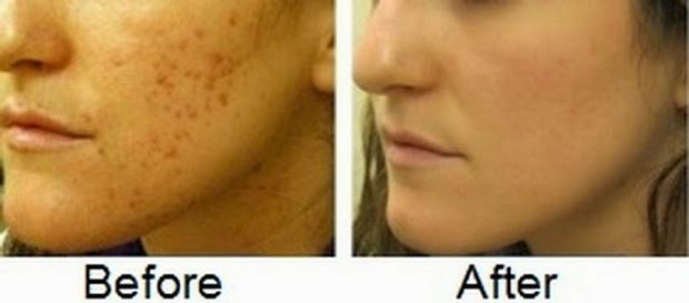 11 mejores remedios para eliminar las cicatrices del acné