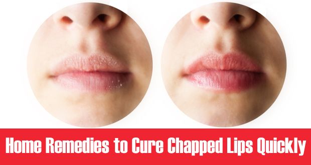 12 Fácil Remedios caseros para los labios agrietados