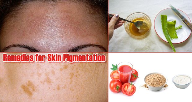 15 Remedios caseros para la pigmentación de la piel