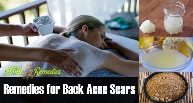 15 remedios naturales para deshacerse de las cicatrices del acné trasero