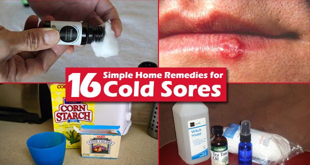 16 remedios caseros simples para el herpes labial