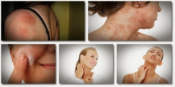 5 remedios herbarios para el eczema