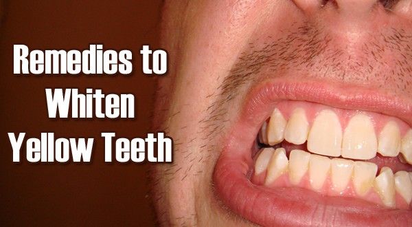 5 remedios sorprendentes para blanquear los dientes amarillos