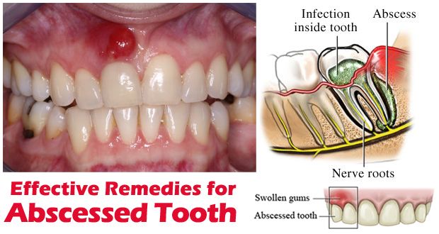Remedios caseros para el absceso dental