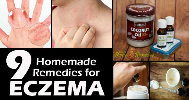 ¿Cómo deshacerse de Eczema