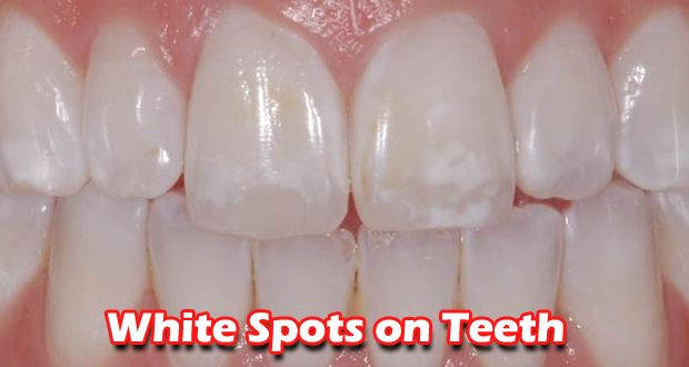 ¿Cómo deshacerse de manchas blancas en los dientes rápidamente