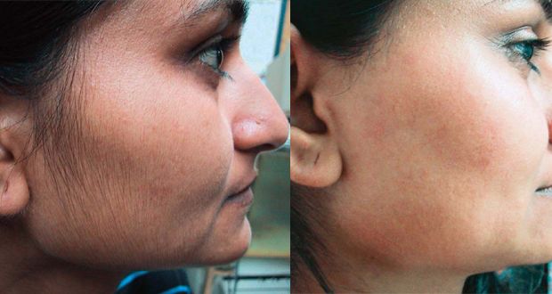 Remedios caseros naturales para la depilación facial
