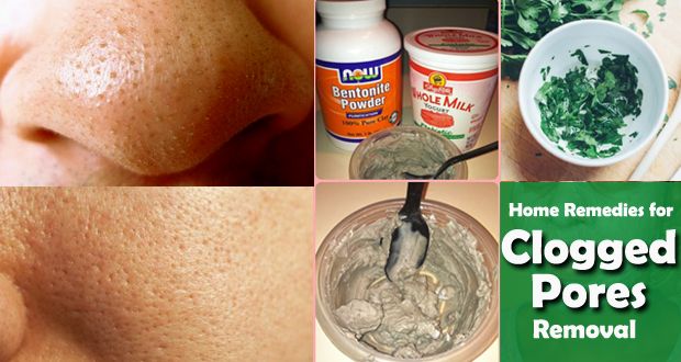 Top 12 remedios caseros para los poros tapados