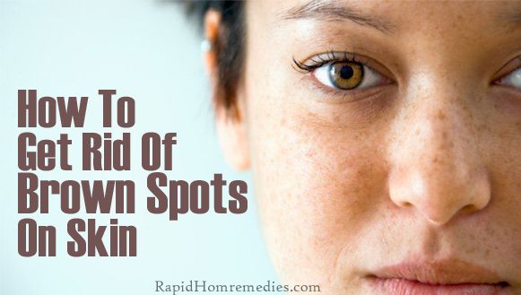 Top 7 remedios para deshacerse de manchas marrones en la piel